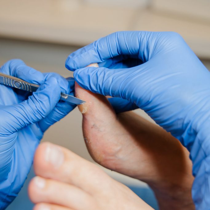 Podoloog verwijderd hyperkeratose met een scalpel.
